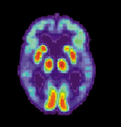 Skan PET mózgu osoby cierpiącej na AD, fot. public domain