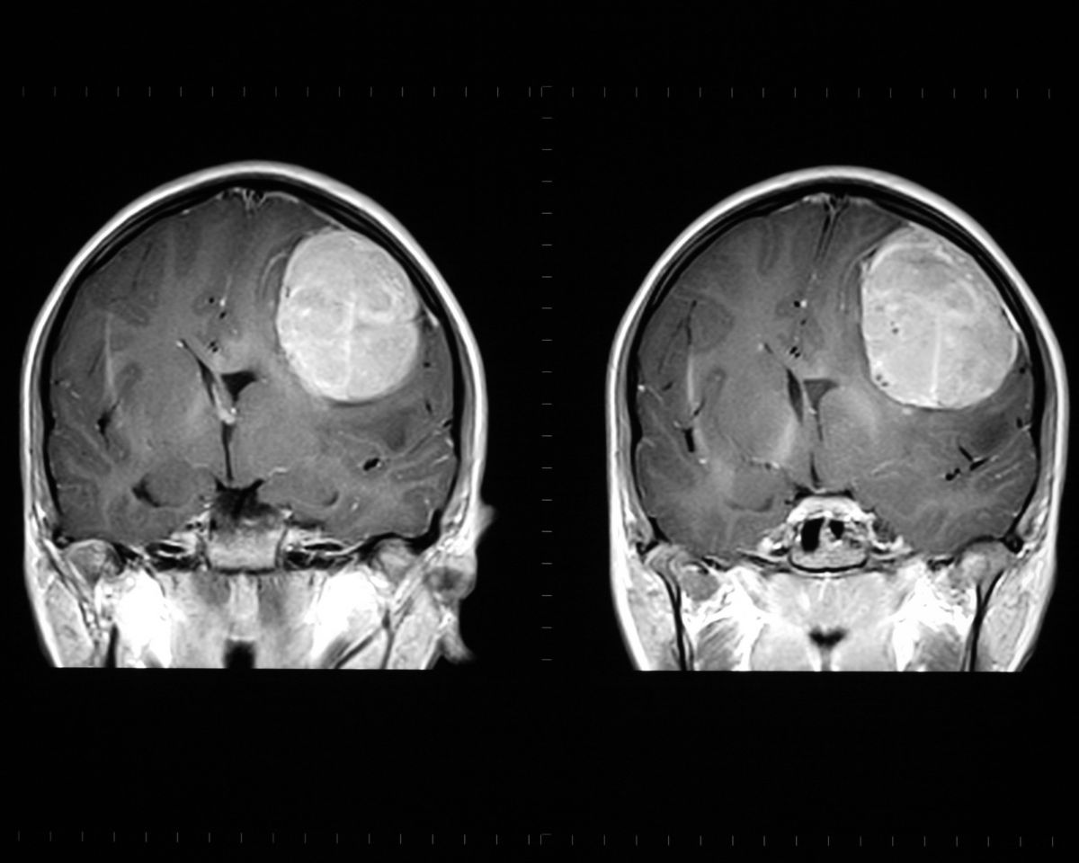 Злокачественное новообразование мозга. Мрт головного мозга опухоль. Доброкачественная опухоль головного мозга мрт. Опухоли головного мозга на мрт менингиома. Снимок головы опухоль головного мозга.